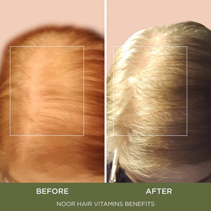 NOOR HAIR Healthy Hair Formula, Hair Growth Supplement Supporting Thick Hair and Fast Hair Regrowth. Vitamin C, B6, Zinc, Propietary Non-GMO & Gluten Free Womens Hair Loss Vitamins